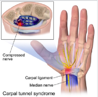 Carpal Tunnel Syndrome Carpal Tunnel Syndrome